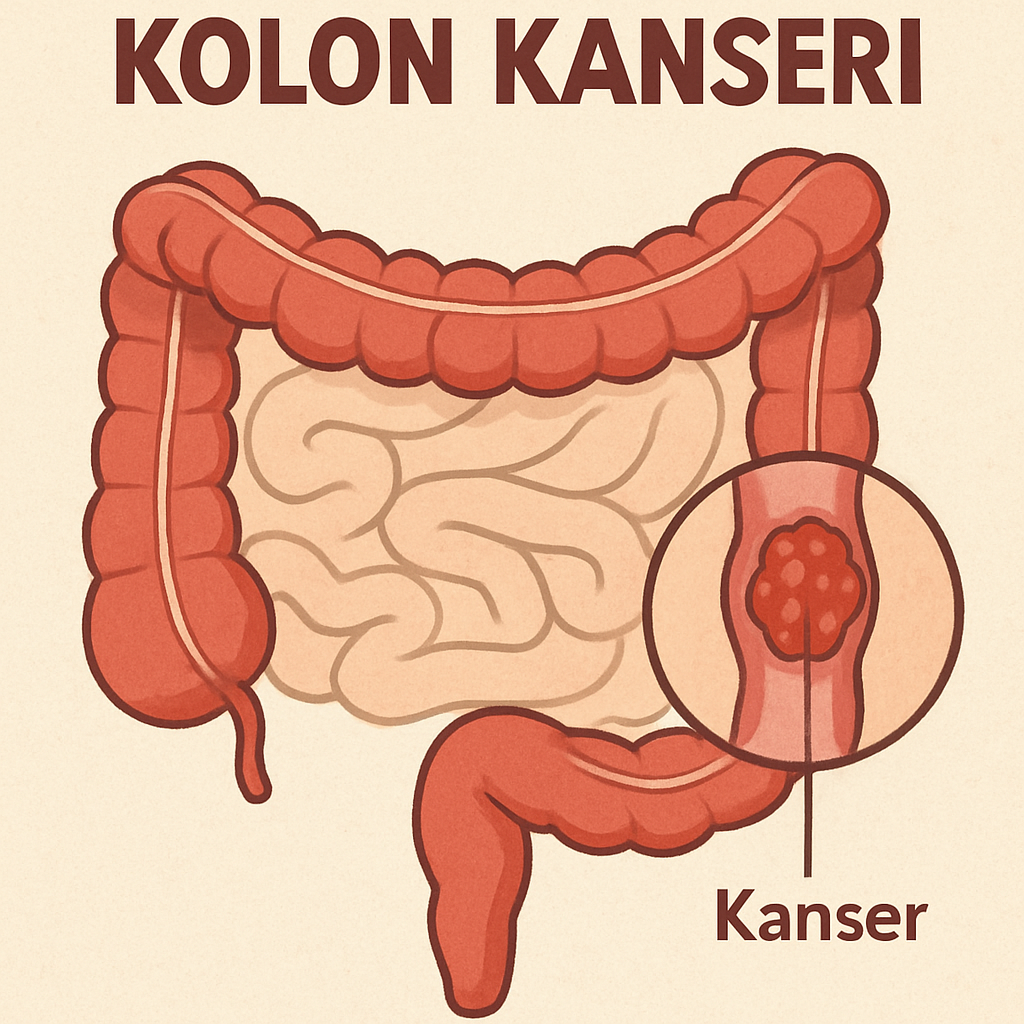 Kolon kanseri hastalığına dair görsel