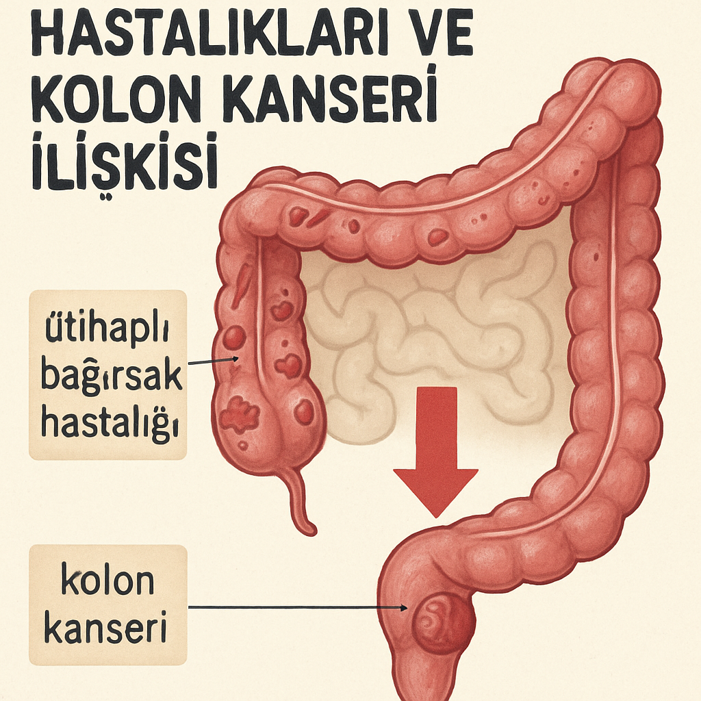 İltihaplı bağırsak hastalıkları ve kolon kanseri ilişkisi
