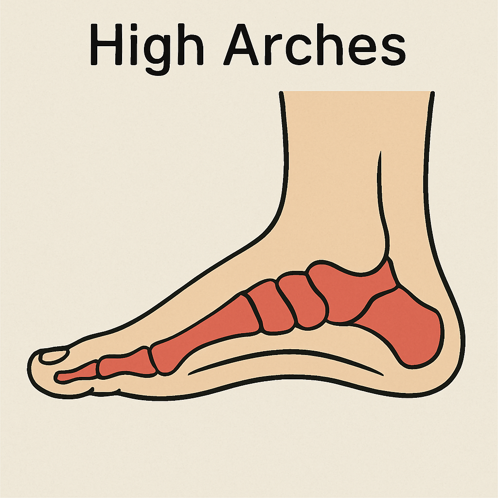 diagram of a foot with high arches