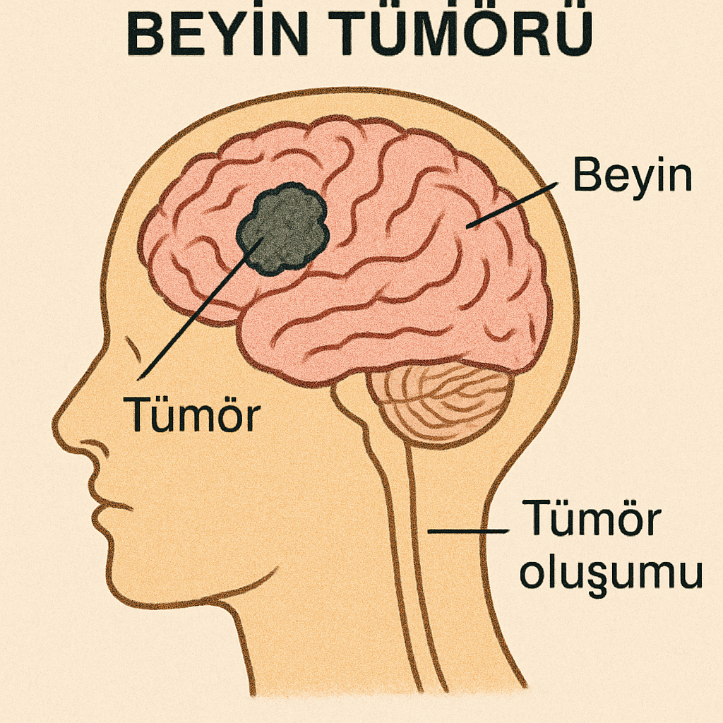Beyin tümörü oluşumunu gösteren bir diyagram